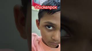 Chickenpox chickenpox doctor ytshorts [upl. by Benji]