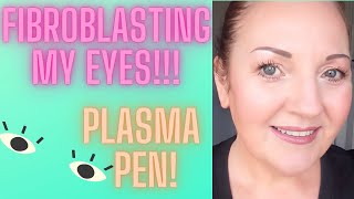 FIBROBLASTING MY EYES PLASMA PEN [upl. by Allsun]