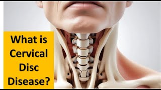 What Is Cervical Disc Disease [upl. by Roda]