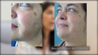 Epilation du visage avec lasers dermatologiques par le Dr Phryné COUTANTFOULC à Nantes 44 [upl. by Yasdnil]