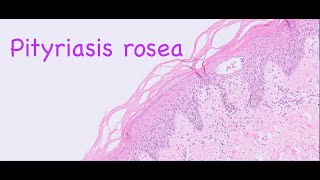 Pityriasis rosea [upl. by Roon722]