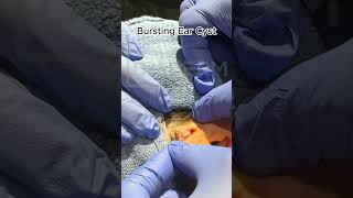 Bursting Ear Cyst  Dr Derm [upl. by Essej]