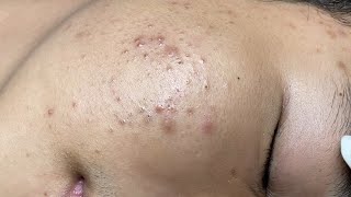 ACNE TREATMENT VU QUYNH MI  Blackheads Of Tweens 2024 EX [upl. by Ytsim732]