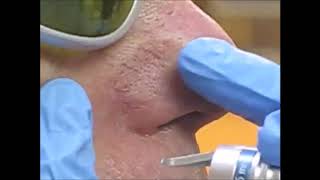 Dornier Medilas D FlexiPulse Laser Treatment [upl. by Gilbye]