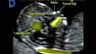 Fetal Medicine Foundation  Nuchal translucency [upl. by Chariot]