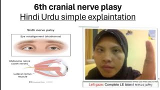 6th cranial nerve palsy in hindi urdu  simple explaintation  cranialnerves plasy [upl. by Ecirtnas]