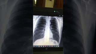 Pleural Effusion Final prof Xray interpretation [upl. by Eneliak874]