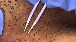 Plucking Ingrown Hairs from Neck [upl. by Solohcin]