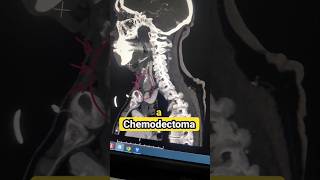 Lump in the neck Chemodectoma Carotid body tumor [upl. by Freida942]