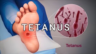 TETANUS [upl. by Shir]