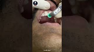 Tooth Filling  Dental Care Clinic 🦷  DrAlka khade shorts tooth dentist [upl. by Kata]