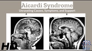 Aicardi Syndrome 101 Causes Symptoms and the Latest in Treatment Strategies [upl. by Elac]