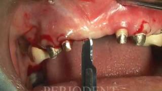 Upper Anterior Esthetic Crown Lengthening and Ridge Augmentation [upl. by Allie426]