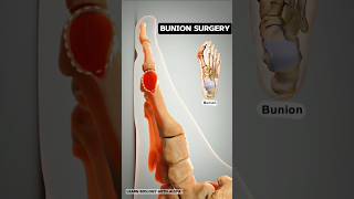 Bunion Surgery  Understanding the Procedure and Recovery 3d animation short [upl. by Olatha65]