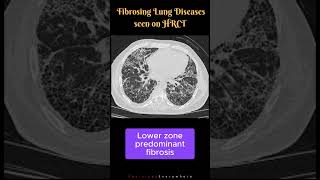 Fibrosing Lung Diseases seen on HRCT Differential Diagnosis UIP NSIP DIP shorts [upl. by Hyrup]