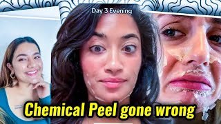 INFLUENCERS NEED TO STOP PROMITING CHEMICAL PEEL AS BEAUTY TREATMENT [upl. by Akimyt]