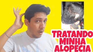 TRATANDO MINHA ALOPECIA [upl. by Royall]