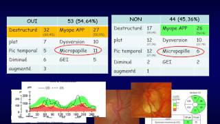 OCT et glaucome [upl. by Zena]