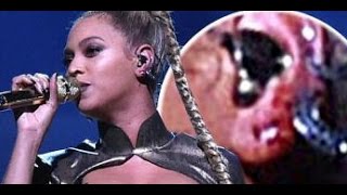 Beyonce Powers Through Tidal Concert Despite BLEEDING Ear Injury [upl. by Lisa]