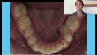 Apparecchio trasparente per adulto denti storti che si incastrano male seconda classe prima dopo [upl. by Noired]