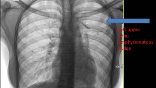 CASE 291 LEFT UPPER EMPHYSEMATOUS BULLAE [upl. by Neron275]