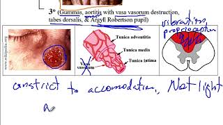 USMLE ACE Video 91 Genital Ulcers [upl. by Ennairod]