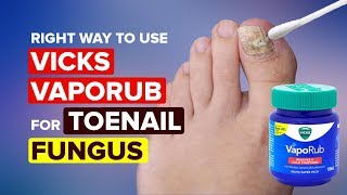 The Right Way To Use Vicks Vaporub for Toenail Fungus  Toenail Fungus Cure [upl. by Deery]