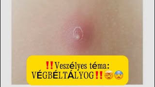 ‼️Veszélyes téma VÉGBÉLTÁLYOG‼️🤯😨 [upl. by Fredette]