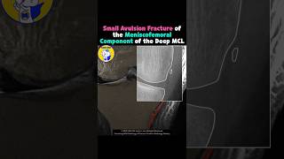 Fig 3A22 Avulsion fracture of meniscofemoral ligament [upl. by Karlotte]