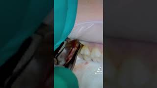 Wisdom Teeth Extraction PROCEDURE  How to Prepare What to Expect amp Cost [upl. by Kauffmann569]