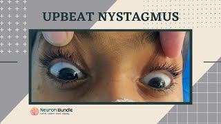 nystagmus  eye movements l demo on a patient l horizontal amp vertical nystagmus neurology [upl. by Jory126]