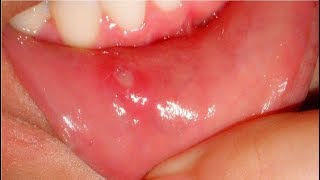 how to get rid of canker sores in minutes [upl. by Amoakuh]