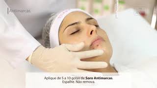 ACNE SOB CONTROLE  RESULTADOS EM 4 DIAS [upl. by Enyehc262]