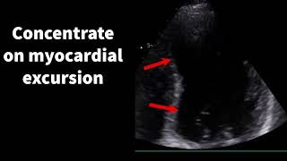 Reverse Takotsubo cardiomyopathy [upl. by Eerehs]