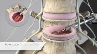 Spineology OptiLIF® Endo [upl. by Mungo229]