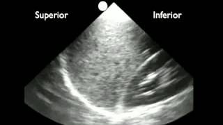 Anleitung Ultraschallerkennung von Pleuraflüssigkeit [upl. by Enirol]