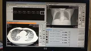 Mild Centrilobular emphysema  emphysema  hrct chest  cough 😷  shortness of breath 🫁 [upl. by Obbard657]