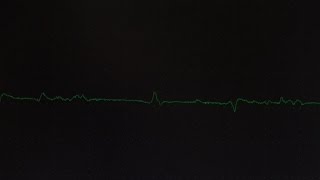 EMG Fibrillations and Fasciculations [upl. by Hsenid]