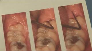 How To Alleviate Infected Wisdom Tooth [upl. by Galven]