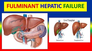 FULMINANT HEPATIC FAILURE [upl. by Hayne]