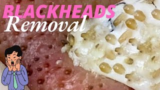 Blackheads Extraction 😲 blackheads problem satisfying blackheads blackheadremoval [upl. by Sandstrom]