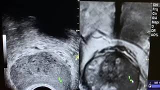 biopsia próstata com fusão de imagens [upl. by Senskell]