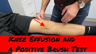 Knee effusion positive brush test and intraarticular knee injury eval [upl. by Heidy83]