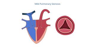 Pulmonary Stenosis [upl. by Marylynne31]