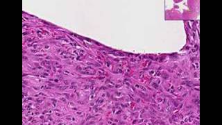 Histopathology ElbowChronic fibrinous bursitis [upl. by Ankney]