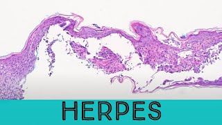 Herpes under the microscope pathology dermpath dermatology dermatopathology HSV VZV zoster [upl. by Tezzil855]