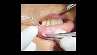 Fibroma Excision using Diode Laser Dr Ankit Goel Hapur [upl. by Cassandra]