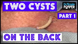 WEB EXCLUSIVE Cysts Removed from the Back Two of em 1 of 2 [upl. by Ru]