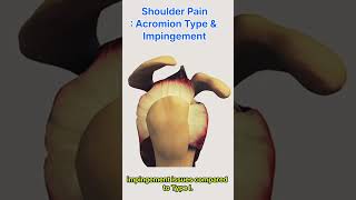 Shoulder Pain  Acromion Type and Impingement Syndrome [upl. by Yahc]