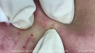 Big Cystic Acne Blackheads Extraction Blackheads amp Milia Whiteheads Removal Pimple Popping [upl. by Calv851]